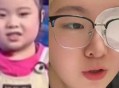 知名童星“秦虹一枝花”右眼失明来穗就医，称无法治愈终身靠药物控制