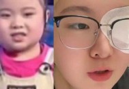知名童星“秦虹一枝花”右眼失明来穗就医，称无法治愈终身靠药物控制